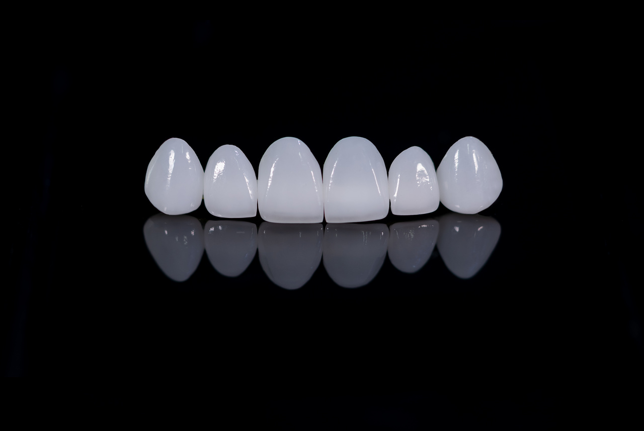 Porcelain dental veneers