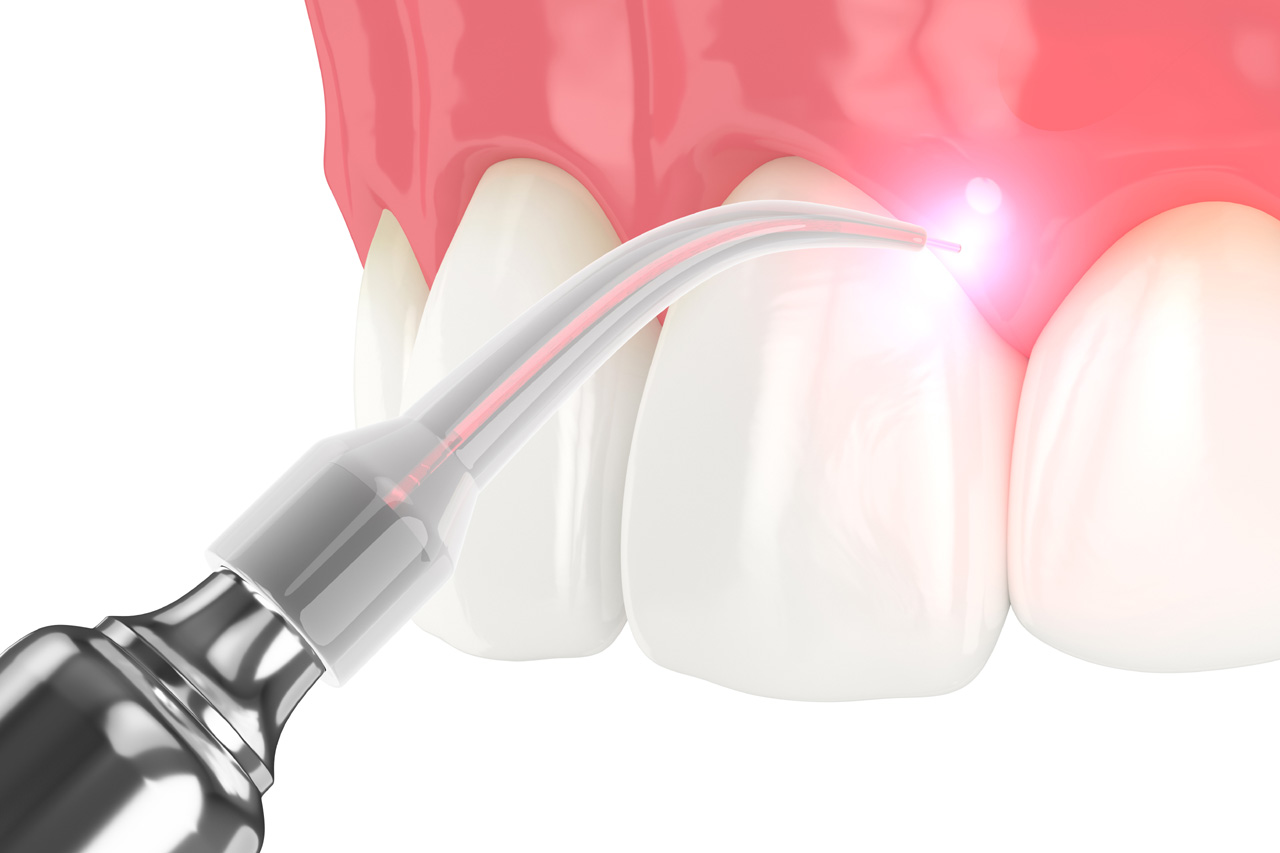 diode laser