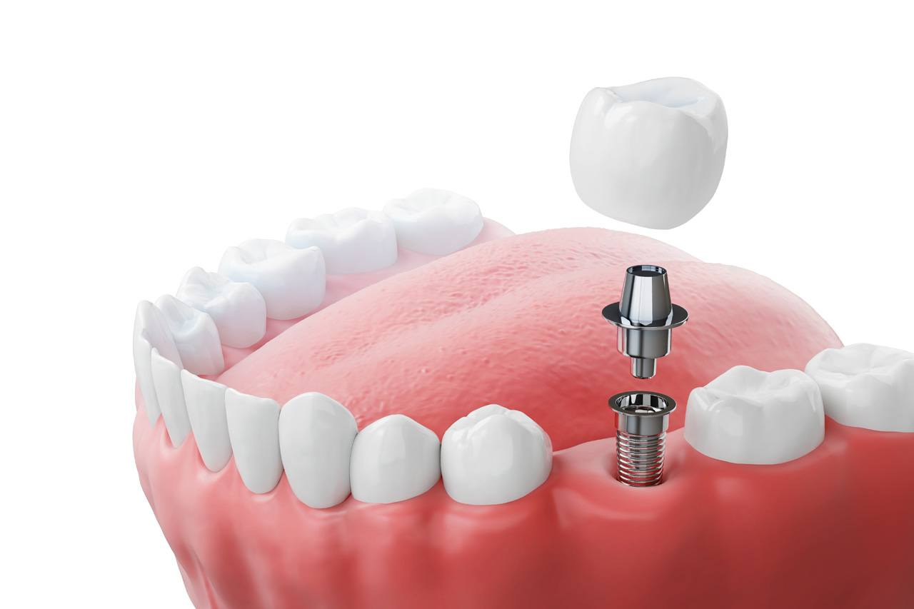 Dental implantation