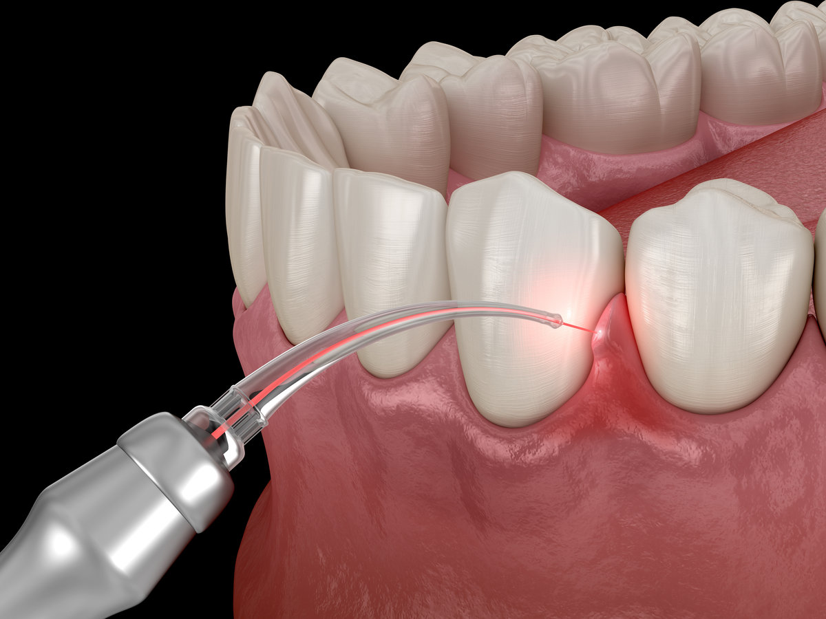 Gum correction surgery with laser. Dental 3D illustration