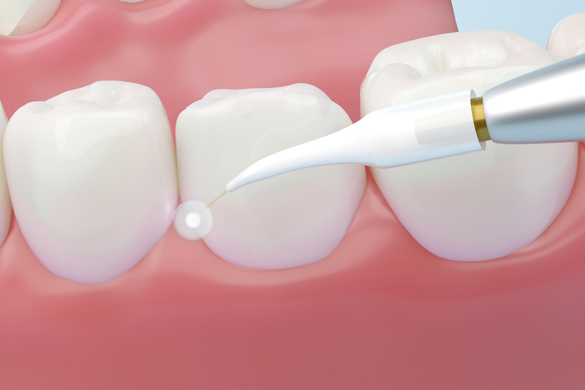 Dental laser tool and white teeth with healthy pink gums. 3D rendering.