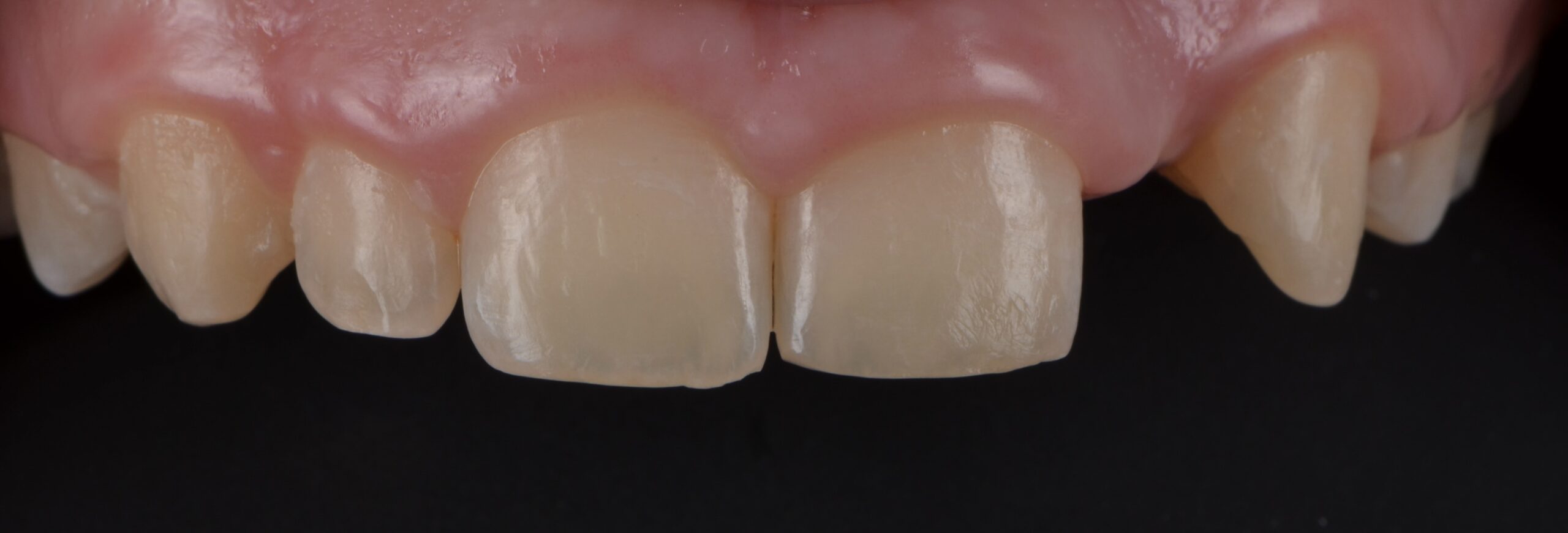 GJ1 scaled - Dental West NYC